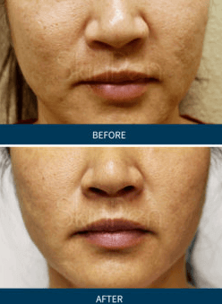 Before and After Microneedling Treatments