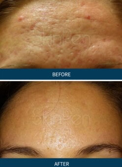 Forehead Before and AFter Microneedling