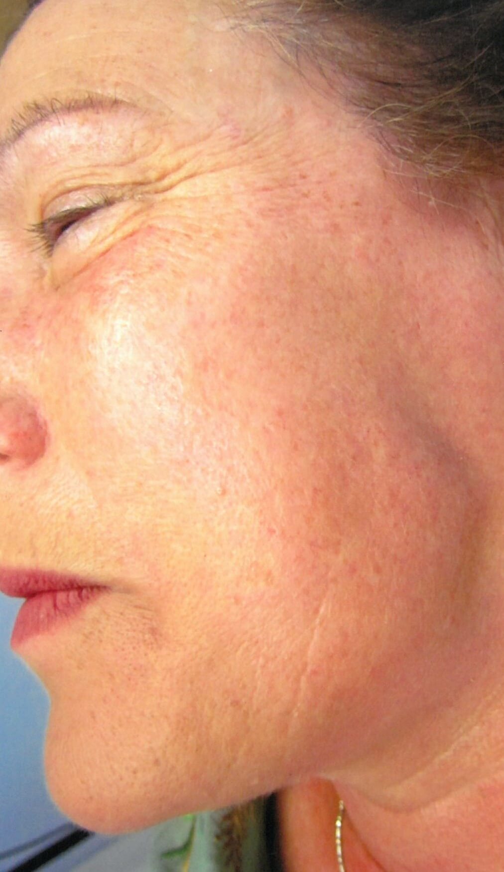 Rosacea: Signs, Symptoms, and Complications